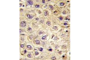 Immunohistochemical staining of formalin-fixed and paraffin-embedded human hepatocarcinoma tissue reacted with TYRO3 monoclonal antibody  at 1:50-1:100 dilution.