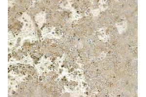 ABIN6260528 and ABIN6273095 at 1/100 staining human melanoma by IHC-P.