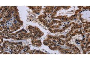 Immunohistochemistry of paraffin-embedded Human gastric cancer tissue using MYCN Polyclonal Antibody at dilution 1:35 (MYCN 抗体)