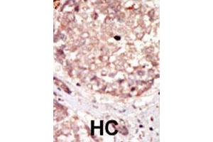Formalin-fixed and paraffin-embedded human hepatocellular carcinoma tissue reacted with HIPK3 polyclonal antibody  , which was peroxidase-conjugated to the secondary antibody, followed by DAB staining. (HIPK3 抗体)