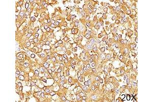 IHC staining of human melanoma (20X) with gp100 antibody (HMB45). (Melanoma gp100 抗体)