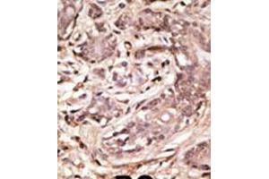 Formalin-fixed and paraffin-embedded human cancer tissue reacted with the primary antibody, which was peroxidase-conjugated to the secondary antibody, followed by AEC staining. (SUMO4 抗体  (AA 34-63))