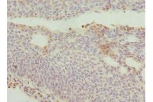 Immunohistochemistry of paraffin-embedded human bladder cancer using ABIN7150145 at dilution of 1:100 (DRAM2 抗体  (AA 182-266))