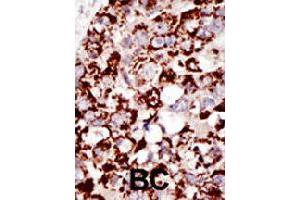 Formalin-fixed and paraffin-embedded human cancer tissue reacted with PIGK polyclonal antibody  , which was peroxidase-conjugated to the secondary antibody, followed by DAB staining . (PIGK 抗体  (C-Term))