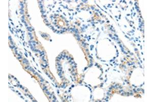 The image on the left is immunohistochemistry of paraffin-embedded Human thyroid cancer tissue using ABIN7189804(ANGPTL5 Antibody) at dilution 1/25, on the right is treated with synthetic peptide. (ANGPTL5 抗体)
