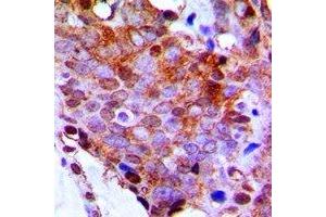 Immunohistochemical analysis of RPL13 staining in human breast cancer formalin fixed paraffin embedded tissue section. (RPL13 抗体)