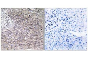 Immunohistochemistry analysis of paraffin-embedded human cervix carcinoma tissue using CHSS2 antibody. (CHPF 抗体  (C-Term))