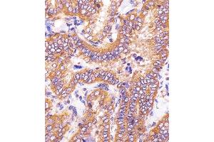 (ABIN6243230 and ABIN6578764) staining HSD17B10 in human thyroid carcinoma sections by Immunohistochemistry (IHC-P - paraformaldehyde-fixed, paraffin-embedded sections). (HSD17B10 抗体  (AA 140-172))