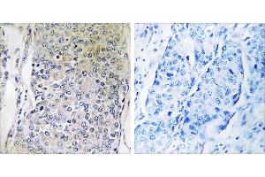 Peptide - +Immunohistochemistry analysis of paraffin-embedded human breast carcinoma tissue using CPXM2 antibody. (CPXM2 抗体)