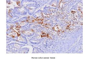 Paraffin embedded sections of human colon canitrocelluloseer tissue were initrocelluloseubated with anti-human FABP1 (1:100) for 2 hours at room temperature. (FABP1 抗体  (AA 1-127))