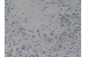 IHC-P analysis of Human Lung Cancer Tissue, with DAB staining. (HMGB1 抗体  (AA 9-163))