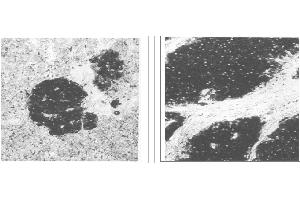 Immunohistochemical staining of normal pancreas tissue (left) and small bowel tumor tissue (center) using NSE antibody (X2070M and X2071M). (Enolase 抗体)