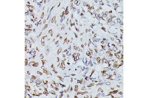 Immunohistochemistry of paraffin-embedded human oophoroma using Lamin B1 antibody (ABIN1513160, ABIN3023296 and ABIN3023297) at dilution of 1:100 (40x lens). (Lamin B1 抗体)