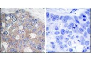 Immunohistochemistry analysis of paraffin-embedded human breast carcinoma tissue, using p70 S6 Kinase (Ab-421) Antibody. (RPS6KB1 抗体  (AA 411-460))