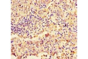 Immunohistochemistry of paraffin-embedded human lung cancer using ABIN7161043 at dilution of 1:100