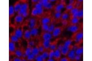 Immunofluorescence analysis of Human liver cancer tissue using Cleaved-CASP3 p12 (D175) Polyclonal Antibody at dilution of 1:200. (Caspase 3 p12 (Cleaved-Asp175) 抗体)