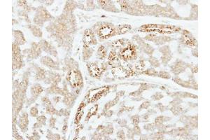 IHC-P Image Immunohistochemical analysis of paraffin-embedded human breast cancer, using Factor XI, antibody at 1:250 dilution. (Factor XI 抗体)