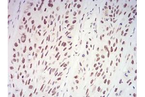Immunohistochemical analysis of paraffin-embedded esophageal cancer tissues using XRN2 mouse mAb with DAB staining. (XRN2 抗体  (AA 398-547))