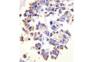 (ABIN1882228 and ABIN2843486) staining CTSD in human lung adenocarcinoma tissue sections by Immunohistochemistry (IHC-P - paraformaldehyde-fixed, paraffin-embedded sections). (Cathepsin D 抗体)