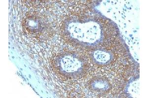 IHC testing of FFPE human cervical squamos cell carcinoma with CD44v4 antibody (clone CD44v4/1219). (CD44v4 抗体)