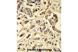 Formalin-fixed and paraffin-embedded human breast carcinoma reacted with VGFR1 Antibody, which was peroxidase-conjugated to the secondary antibody, followed by DAB staining. (FLT1 抗体)