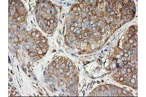Immunohistochemical staining of paraffin-embedded Adenocarcinoma of Human breast tissue using anti-TUBB4 mouse monoclonal antibody. (TUBB4 抗体)
