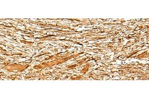 Immunohistochemistry of paraffin-embedded Human liver cancer tissue using ADGRF1 Polyclonal Antibody at dilution of 1:35(x200) (G Protein-Coupled Receptor 110 抗体)