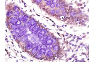Paraformaldehyde-fixed, paraffin embedded human colon caricinoma, Antigen retrieval by boiling in sodium citrate buffer (pH6) for 15min, Block endogenous peroxidase by 3% hydrogen peroxide for 30 minutes, Blocking buffer (normal goat serum) at 37°C for 20min, Antibody incubation with PP2A beta Polyclonal Antibody  at 1:400 overnight at 4°C, followed by a conjugated secondary and DAB staining.