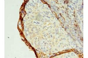 Immunohistochemistry of paraffin-embedded human breast cancer using ABIN7159148 at dilution of 1:100 (MED28 抗体  (AA 1-178))