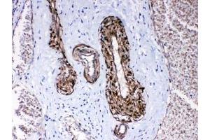 IHC testing of FFPE human lung cancer tissue with CPI-17 antibody at 1ug/ml. (CPI-17 抗体)