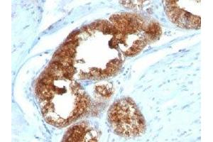 IHC staining of human prostate carcinoma with TAG-72 antibody cocktail (B72. (TAG-72 抗体)