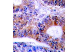 Immunohistochemical analysis of Cytokeratin 20 staining in human colon cancer formalin fixed paraffin embedded tissue section. (KRT20 抗体  (C-Term))
