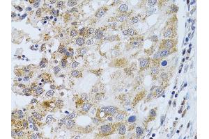 Immunohistochemistry of paraffin-embedded human breast cancer using PHLDA2 antibody (ABIN6292224) at dilution of 1:100 (40x lens).
