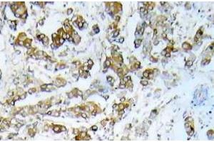 Immunohistochemistry (IHC) analyzes of HSP27 pAb in paraffin-embedded human breast carcinoma tissue. (HSP27 抗体)
