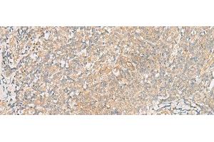 Immunohistochemistry of paraffin-embedded Human tonsil tissue using TRAF6 Polyclonal Antibody at dilution of 1:30(x200) (TRAF6 抗体)