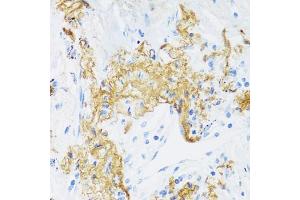 Immunohistochemistry of paraffin-embedded human lung cancer using ELN antibody (ABIN6291688) at dilution of 1:100 (40x lens). (Elastin 抗体)
