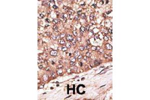 Formalin-fixed and paraffin-embedded human hepatocellular carcinoma tissue reacted with WISP1 polyclonal antibody  , which was peroxidase-conjugated to the secondary antibody, followed by DAB staining. (WISP1 抗体  (Internal Region))