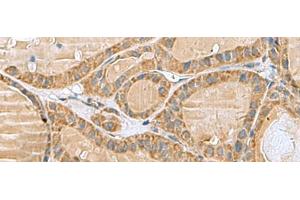 Immunohistochemistry of paraffin-embedded Human thyroid cancer tissue using MRPL40 Polyclonal Antibody at dilution of 1:80(x200) (MRPL40 抗体)