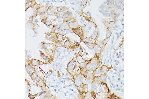 Immunohistochemistry of paraffin-embedded Human lung adenocarcinoma using PD-L1/CD274/CD274 Rabbit mAb (ABIN7266181) at dilution of 1:200 (40x lens). (PD-L1 抗体  (Extracellular Domain))