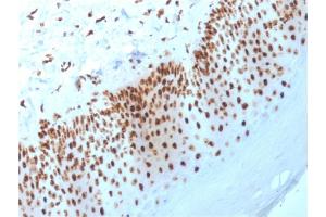 Formalin-fixed, paraffin-embedded human Basal Cell Carcinoma stained with Nucleophosmin Mouse Monoclonal Antibody (NPM1/3398). (NPM1 抗体  (AA 185-287))