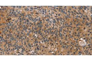 Immunohistochemistry of paraffin-embedded Human esophagus cancer tissue using TAC1 Polyclonal Antibody at dilution 1:25 (TAC1 抗体)