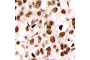 Immunohistochemical analysis of C/EBP zeta staining in human breast cancer formalin fixed paraffin embedded tissue section. (DDIT3 抗体  (N-Term))