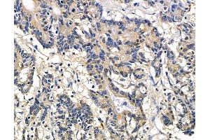 ABIN7097056 and ABIN7101123 at 1/100 staining human colorectal cancer and adjacent non-tumor tissue by IHC-P. (NHLRC2 抗体)