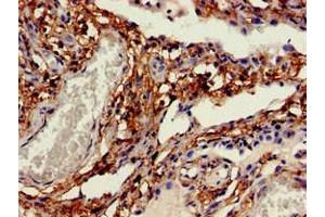 Immunohistochemistry of paraffin-embedded human lung cancer using ABIN7146203 at dilution of 1:100 (OB Cadherin 抗体  (AA 637-796))