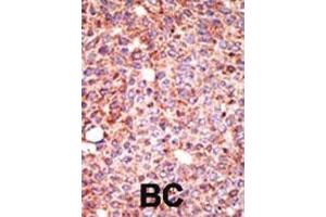 Formalin-fixed and paraffin-embedded human cancer tissue reacted with the primary antibody, which was peroxidase-conjugated to the secondary antibody, followed by AEC staining. (MGAT3 抗体  (N-Term))