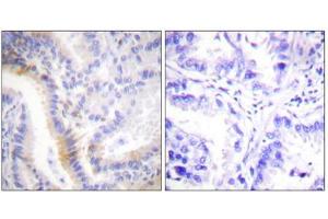 Immunohistochemistry analysis of paraffin-embedded human lung carcinoma tissue, using urocortin antibody. (Urocortin 抗体  (C-Term))