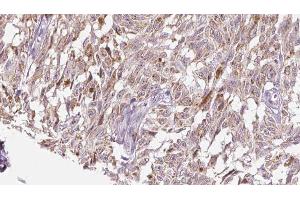 ABIN6276527 at 1/100 staining Human Melanoma tissue by IHC-P. (CRH 抗体  (N-Term))