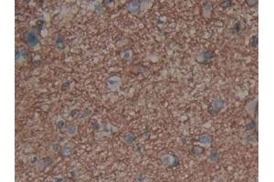 Detection of AQP4 in Human Glioma Tissue using Polyclonal Antibody to Aquaporin 4 (AQP4) (Aquaporin 4 抗体  (AA 178-317))