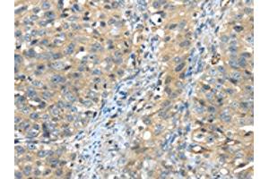 The image on the left is immunohistochemistry of paraffin-embedded Human breast cancer tissue using ABIN7191125(ISM2 Antibody) at dilution 1/45, on the right is treated with synthetic peptide. (Isthmin 2 抗体)