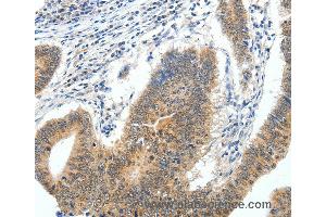 Immunohistochemistry of Human gastric cancer using ECE2 Polyclonal Antibody at dilution of 1:40 (ECE2 抗体)